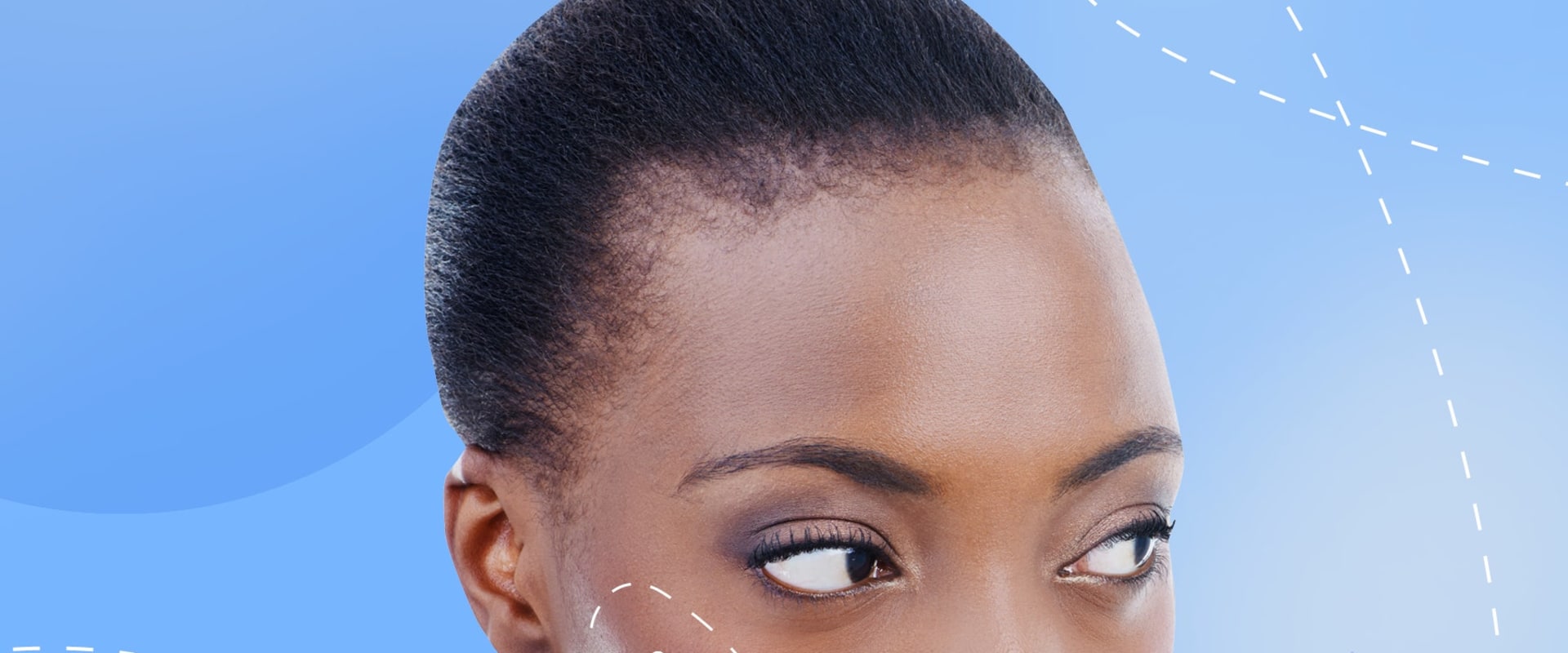 How Long Will Cheek Filler Last and Go Down?