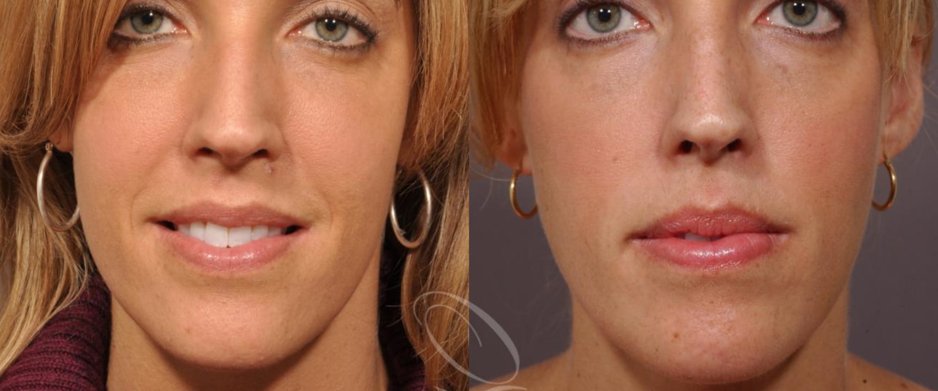 Cheek Augmentation: A Comprehensive Guide