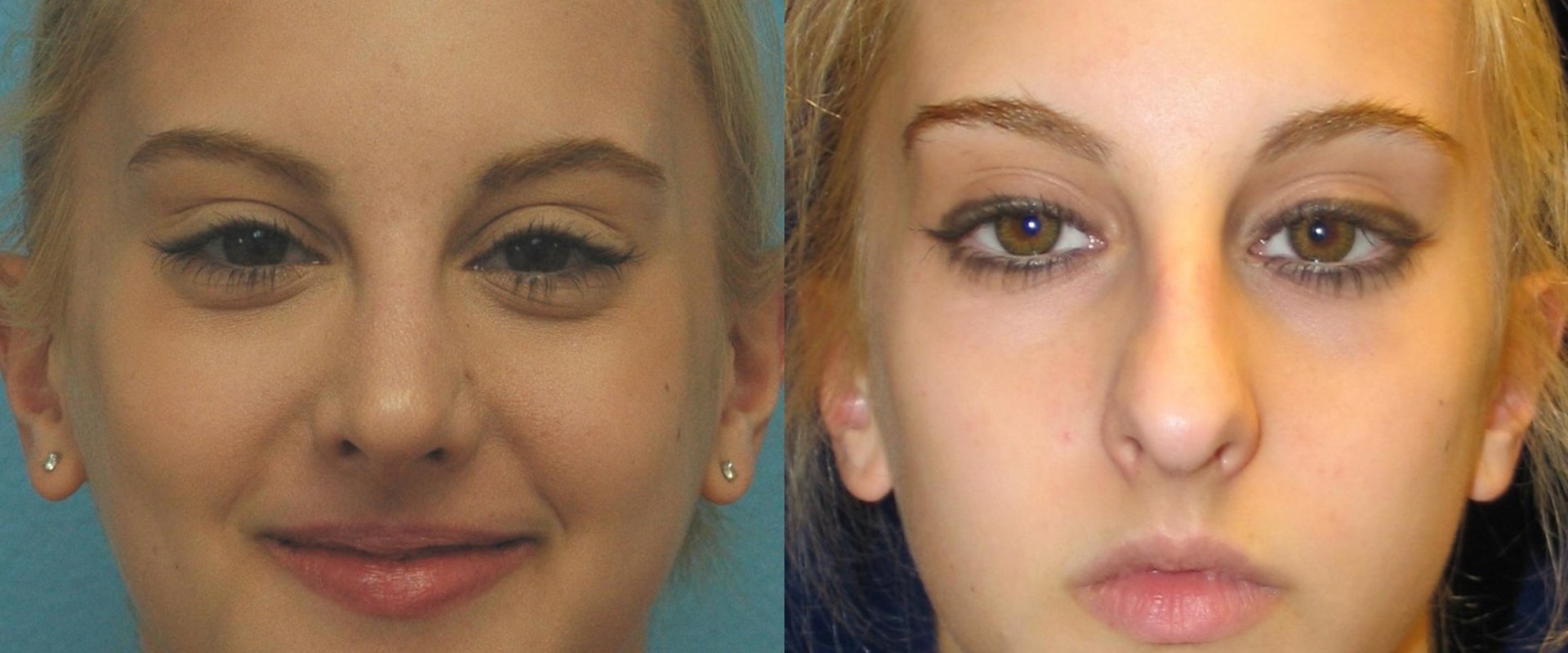 Cheekbone Augmentation: Everything You Need to Know About Cheek Implant Removal