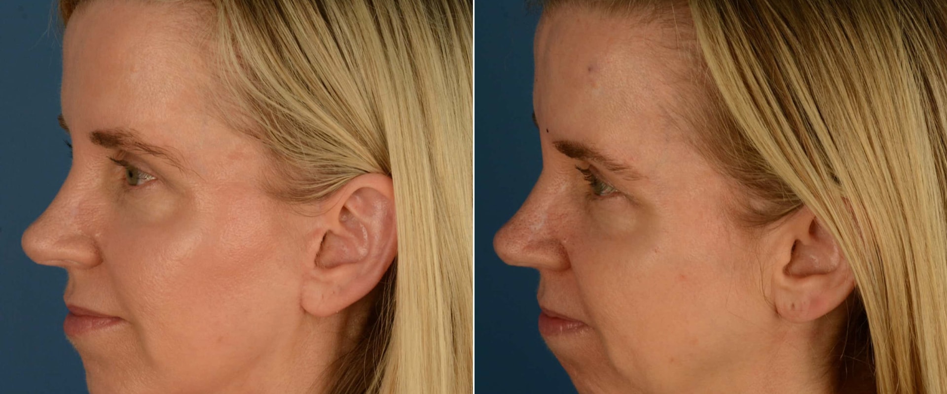 Can Cheek Implants Move? A Comprehensive Guide