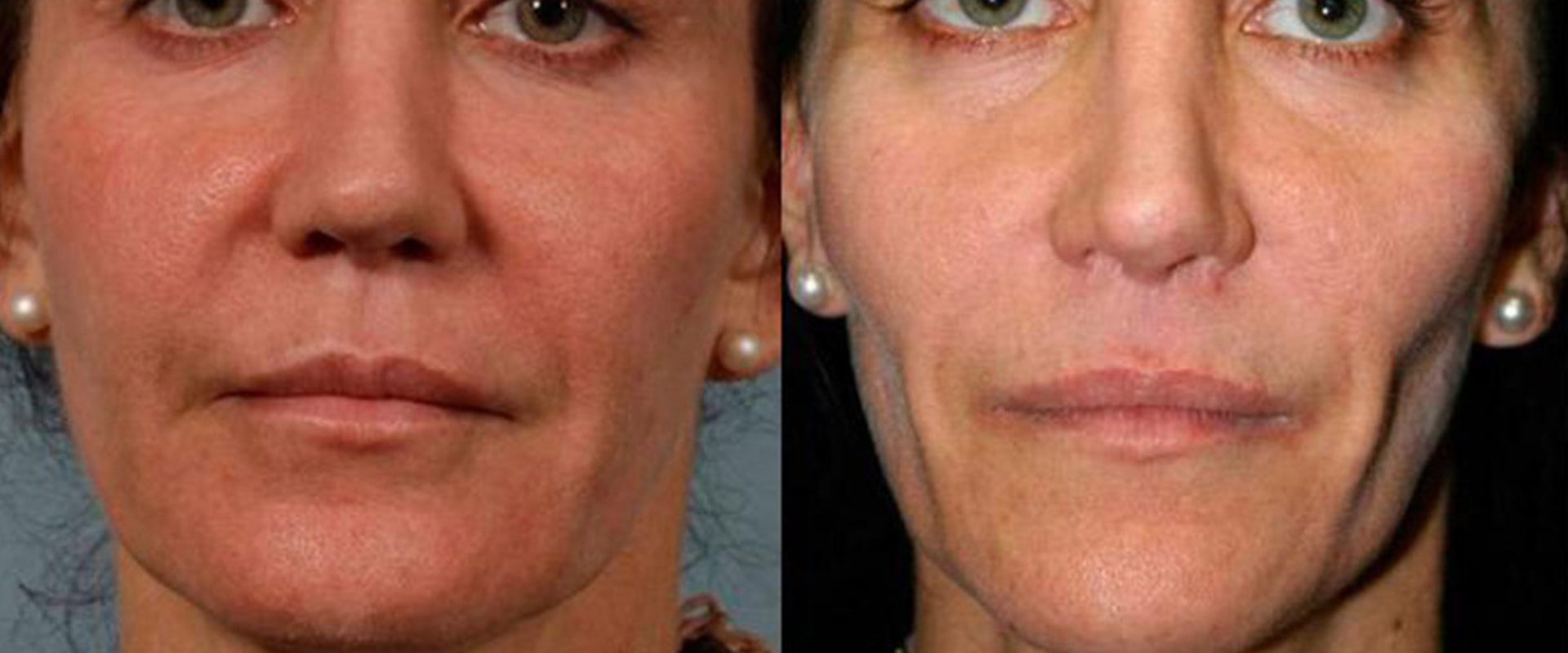 Can Cheek Filler Affect Sinus Infections?