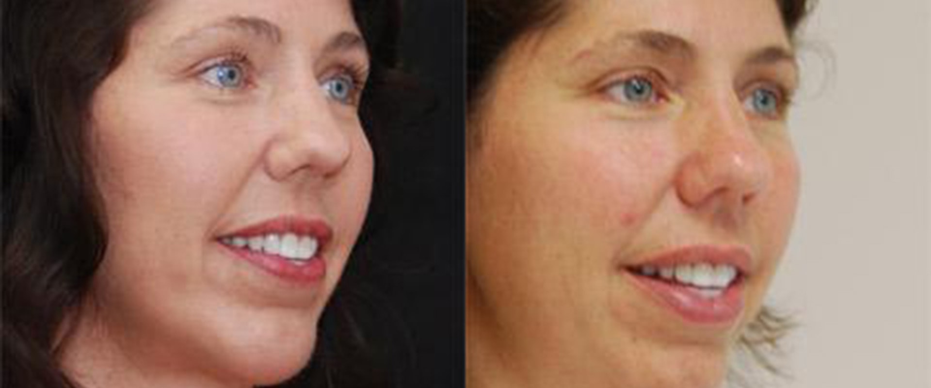 Cheek Augmentation: What Incisions Are Used?