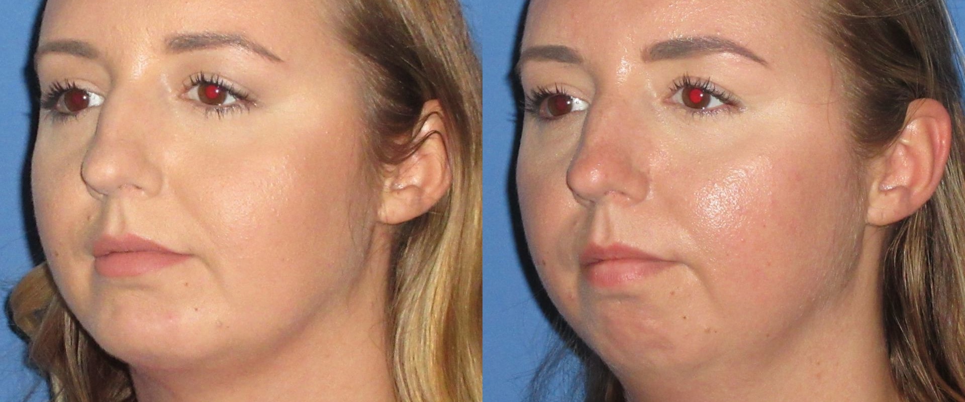 How Much Does Cheek Augmentation Cost? A Comprehensive Guide