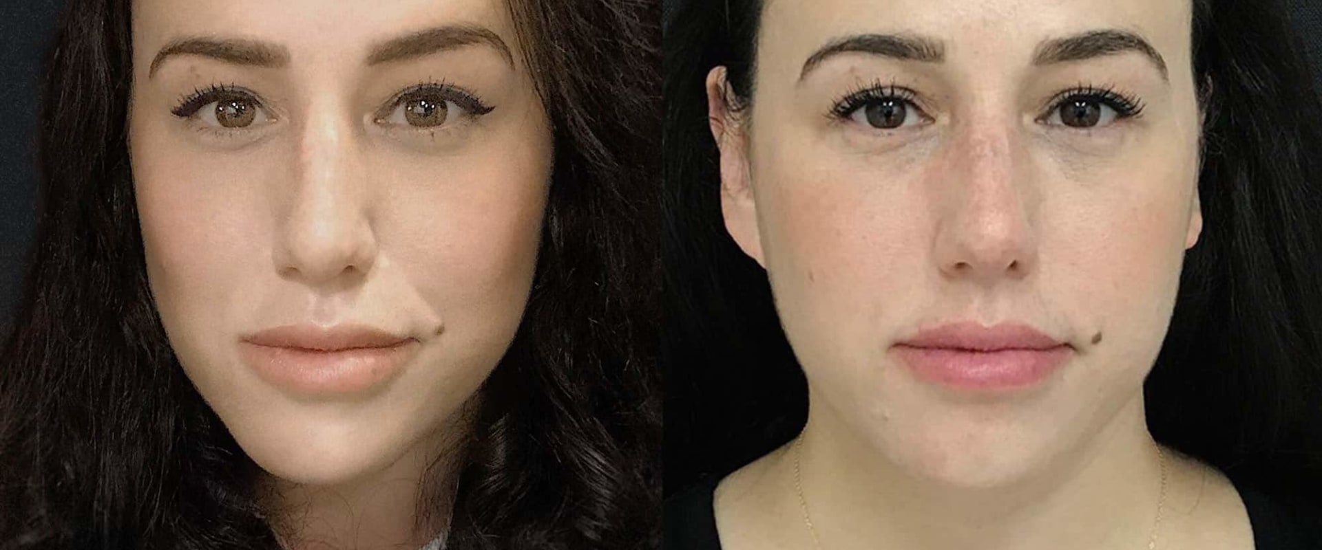 How Long Does Cheek Augmentation Take? A Comprehensive Guide