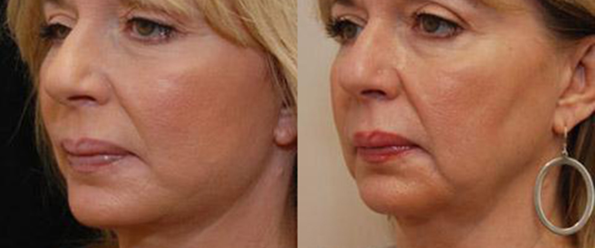 How Much Does Cheek Reconstruction Cost? A Comprehensive Guide