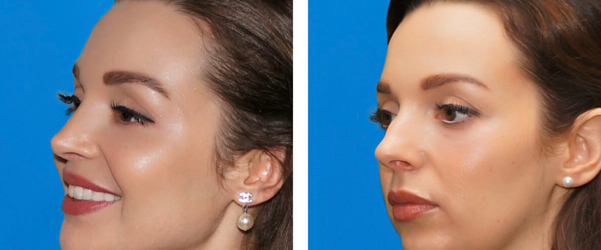 Cheek Implants: A Permanent Way to Enhance Your Appearance