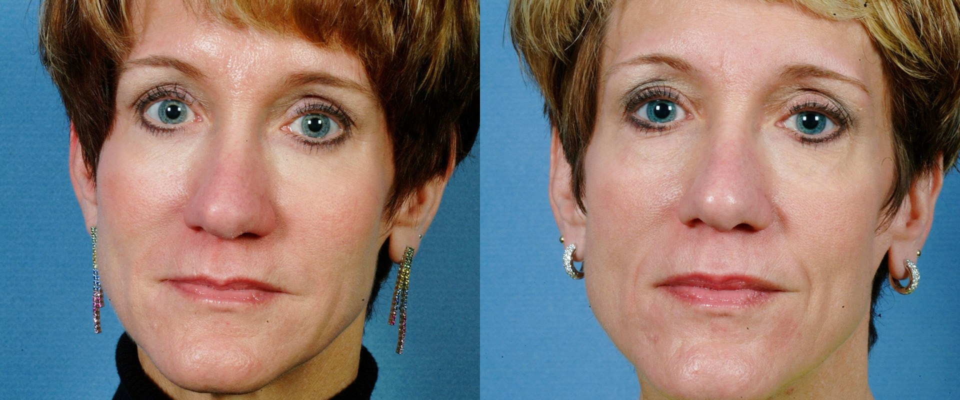 Achieving a Youthful Look with Cheek Implants