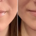Cheek Filler: How Long Does It Take to Soften and Settle?