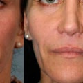 Can Cheek Filler Affect Sinus Infections?