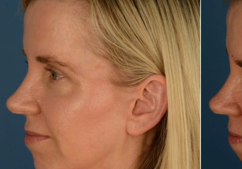 Can Cheek Implants Move? A Comprehensive Guide
