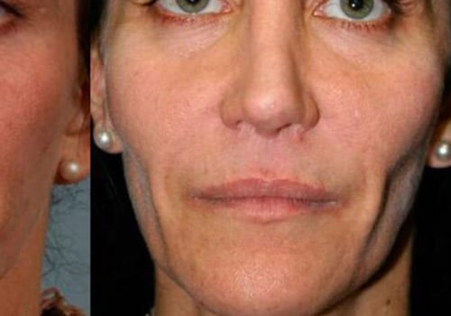 Can Cheek Filler Affect Sinus Infections?