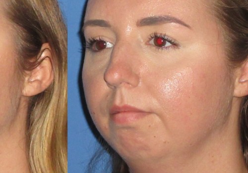 How Much Does Cheek Augmentation Cost? A Comprehensive Guide