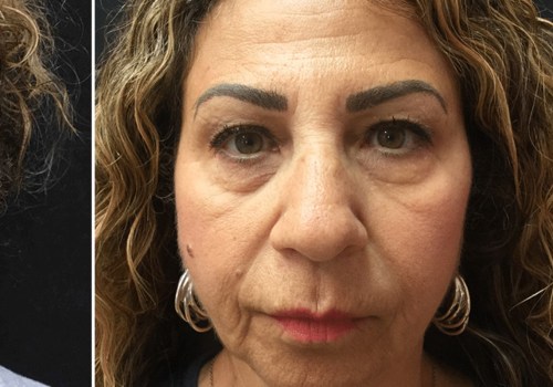 Can Filler in Cheeks Lift Jowls?