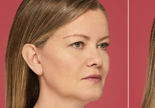 Cheek Fillers: The Secret to a Youthful and Contoured Face