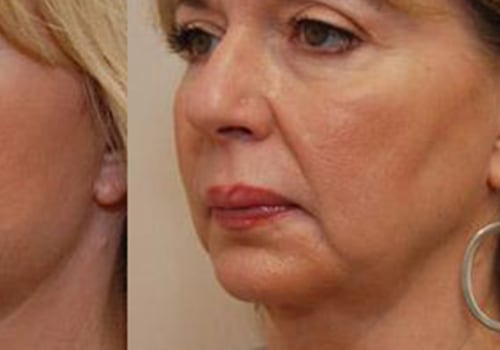 How Much Does Cheek Reconstruction Cost? A Comprehensive Guide