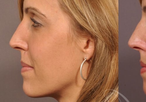 Cheek Augmentation: Before and After Results